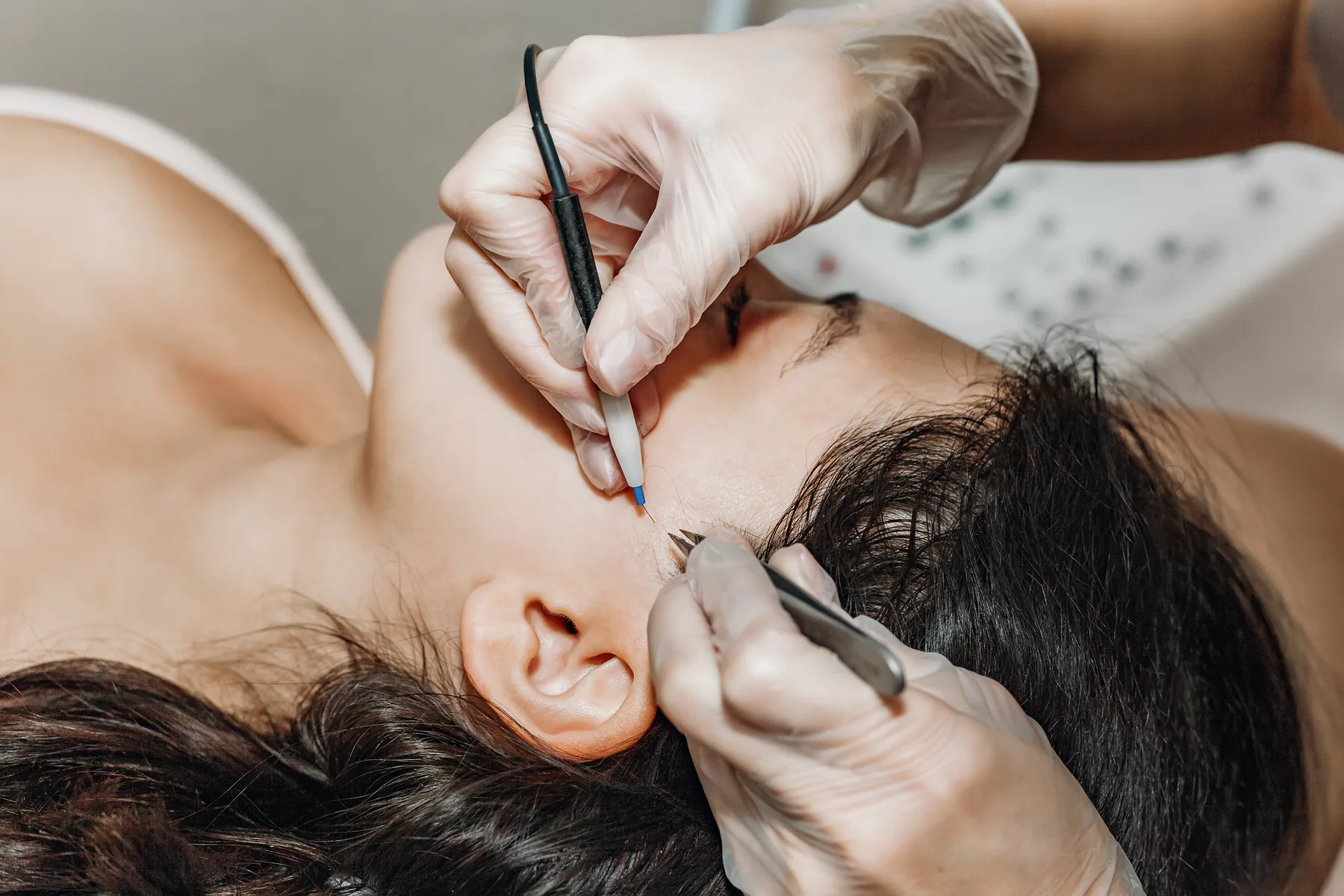 Close-up electrolysis treatment near the face